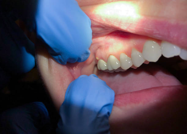 Best Urgent Care for Lost Fillings or Crowns in Orlando, FL