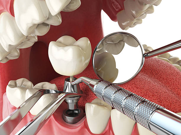 Best Emergency Dental Care for Broken or Chipped Teeth in Orlando, FL